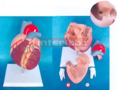 MIDDLE HEART WITH ATRIAL SEPTAL DEFECT